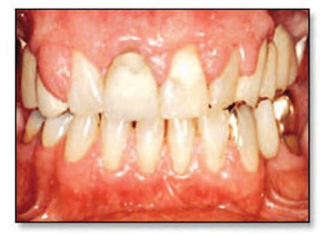 Clinical presentation of gingival hyperplasia. | Download Scientific ...