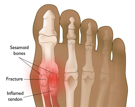 Sesamoiditis and Sesamoid Fracture - OrthoInfo - AAOS