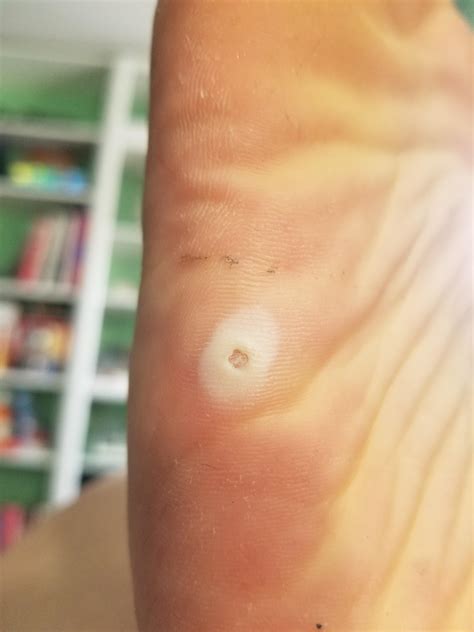 My foot wart came off all at once and left a hole. : r/mildlyinteresting