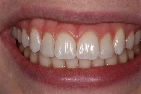 After dental bonding procedure - Center for Contemporary Dentistry - Madison, Mississippi