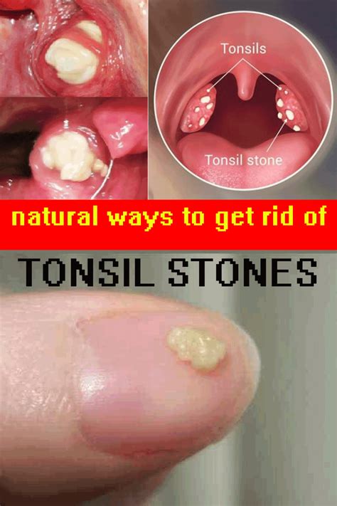 Cancer In Tonsils And Lymph Nodes