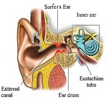 Ear exostosis (surfer's ear)