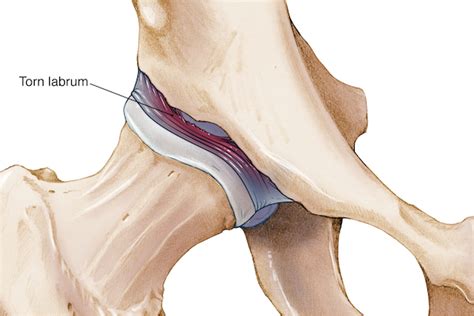 Hip acetabular/labral tear