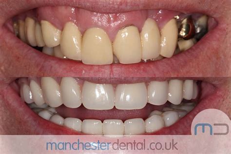 Same Day Implants - Manchester Dental