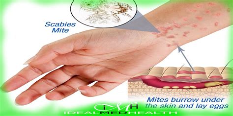 Pathophysiology of scabies - idealmedhealth