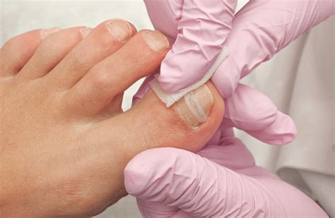 Ingrown Toenail Removal Phoenix AZ | Ingrown Nail Doctor | Valley Foot Care