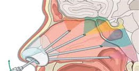 Brain Tumor: Causes, Classification & Surgery Procedure - Brain-Surgery.com