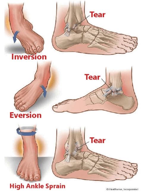 Ankle Sprain Symptoms Causes Treatment Ankle Sprain