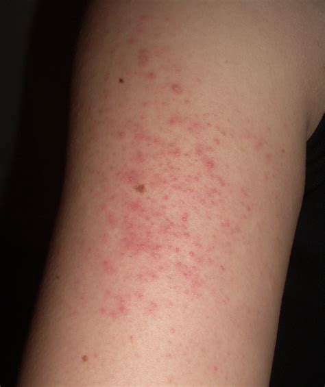 Itchy Rash From Stress