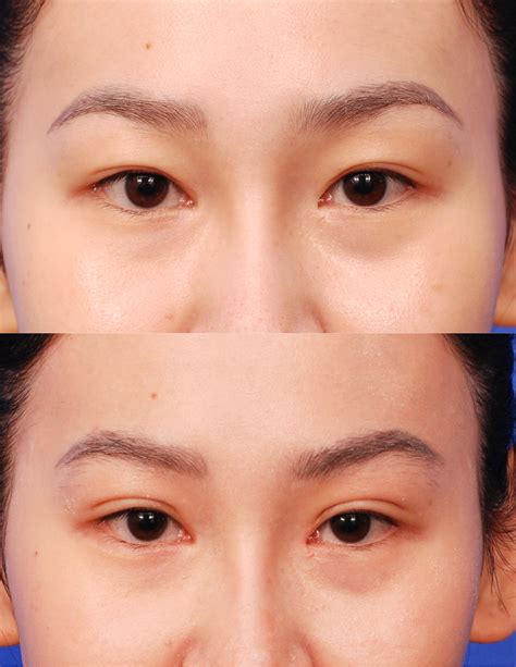 Asian Blepharoplasty | Double Eyelid Surgery - San Diego — SKY Facial Plastic Surgery