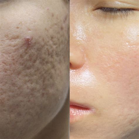 Acne Scar & Pore Reduction Laser Treatment Melbourne