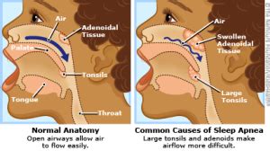 snoring, apnoea in children, sleep disturbance,