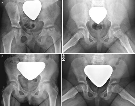 Legg-Calvé-Perthes Disease: Treatments | Radiology Key