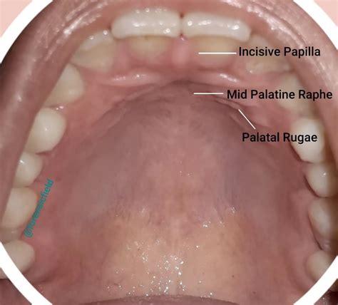 Palatal Rugae - Forensic's blog