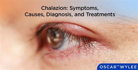 Chalazion: Symptoms, Causes, Diagnosis, and Treatments