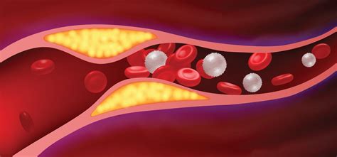 Arteries with clogged fat that causes blood clots. 1937778 Vector Art ...