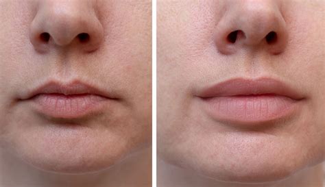 What Are Fillers And How Can They Help Improve Your Appearance ...