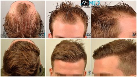 ASMED | Hair Transplant Results Gallery - Norwood 2 - Dr Koray Erdogan ...