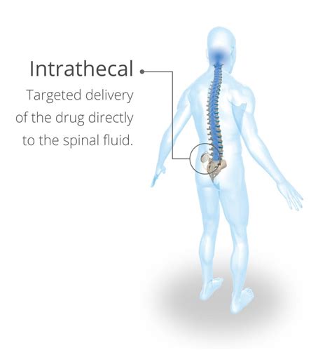 LIORESAL® INTRATHECAL (baclofen injection) - Lioresal® Intrathecal