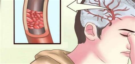 This Remedy May Help You Unclog Arteries Without Surgery