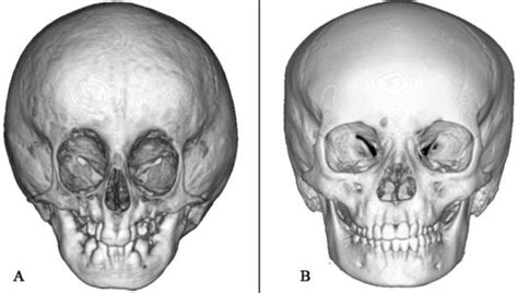 Craniofacial Surgery - A Look into Benefits & Techniques - Dr Anurag Bhargava