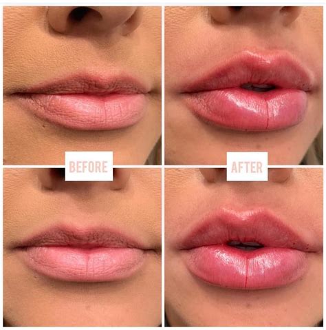 Lips by @lina_sev_ 1 Full Syringe of Juvederm Ultra XC Currently Taking appointments! Space is ...