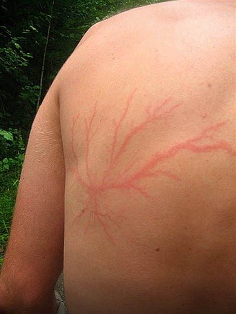 Scars from Lightning Strikes Look Remarkably Like Tattoos - Inked Magazine | Cicatrice de foudre ...