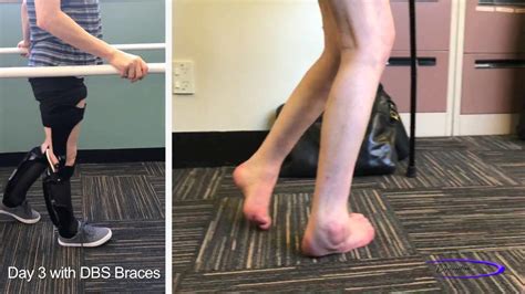 Spastic Paraplegia: Before vs. Day 3 with DBS leg braces - YouTube