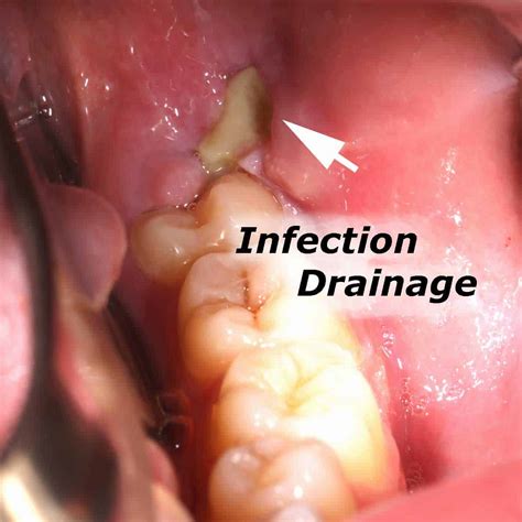 Infected Wisdom Tooth