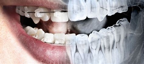 HISTORIA DE LA RADIOLOGÍA DENTAL timeline | Timetoast timelines