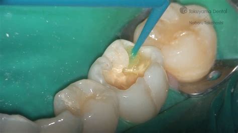 Posterior tooth direct restoration with resin composite – DentalmedTV