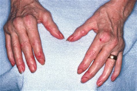 Illustrated - Rheumatoid arthritis | GPonline