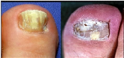 Fungus around toe nails can kill bacteria that cause life threatening infections