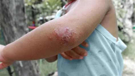 Itchy Elbow Rash Causes at Chana Ryan blog