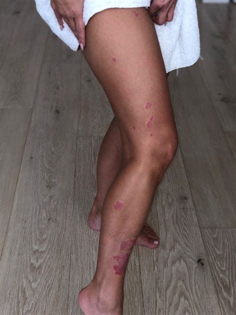 Kim Kardashian Shares Her Journey with Psoriasis - Poosh