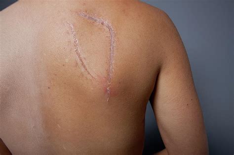 Breast Cancer Surgery Scar Photograph by Larry Dunstan/science Photo Library - Pixels