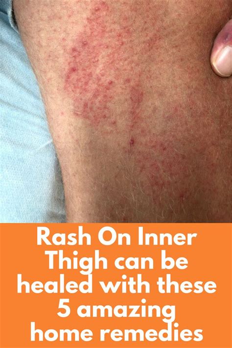 Fungal Rash On Inner Thigh