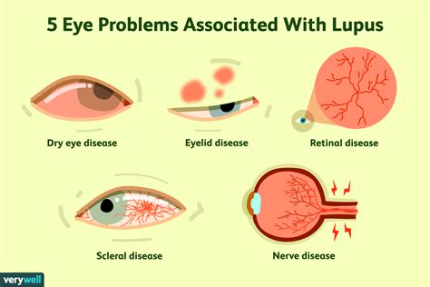 5 Ways Lupus Affects the Eyes