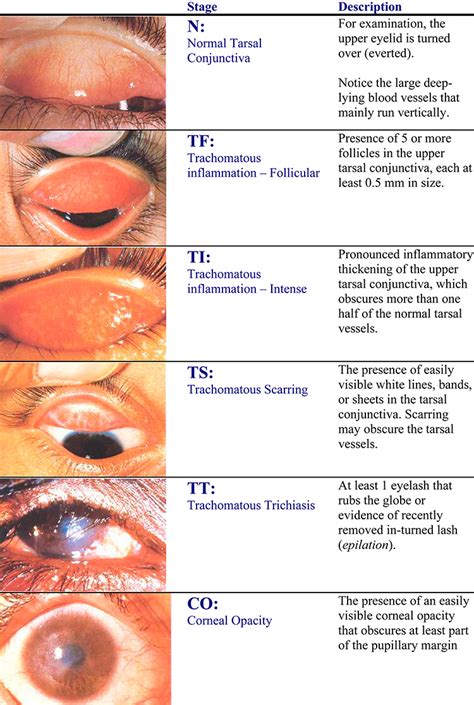 Trachoma Eye