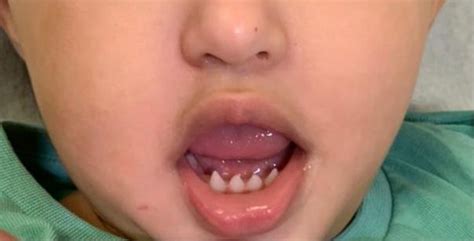 Ectodermal Dysplasia Teeth