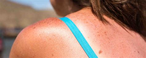 When to Seek Medical Treatment for a Severe Sunburn