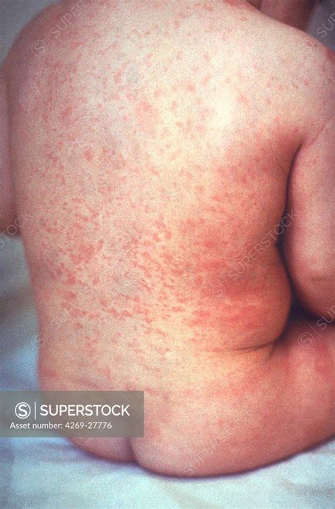 Rubella. Rash of rubella on skin of child's back. - SuperStock