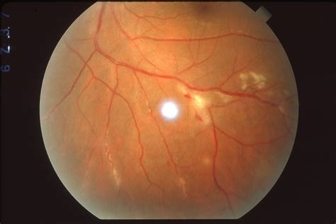 Eales Disease - Retina Image Bank