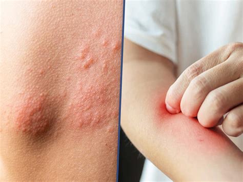 Debunking Top 5 Myths About Atopic Dermatitis | OnlyMyHealth