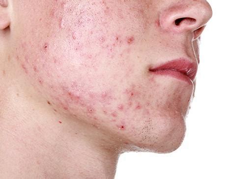 Living with Adult Acne: Dermatology Associates of Central NJ: Dermatologists