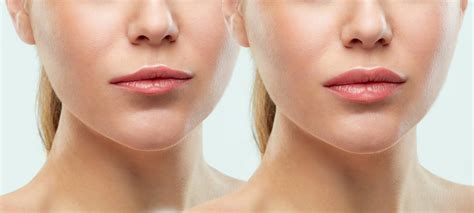 Lip Fillers Treatment - Are Lip Fillers Permanent? Complete Guide