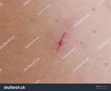 Rash Abrasion On Skin Problem Skin Stock Photo 732162565 | Shutterstock