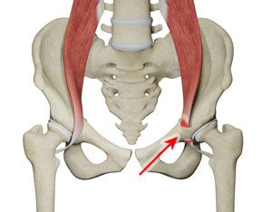 Iliopsoas Tendon Lengthening Long Island, NY | Iliopsoas Tendinitis Suffolk County, NY