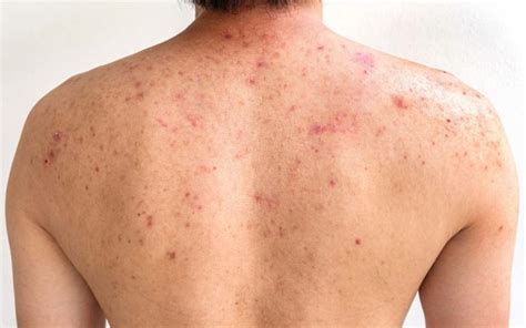 Back Acne Scars: Causes, Symptoms, Diagnosis, Treatment, Prevention, & - Healthroid