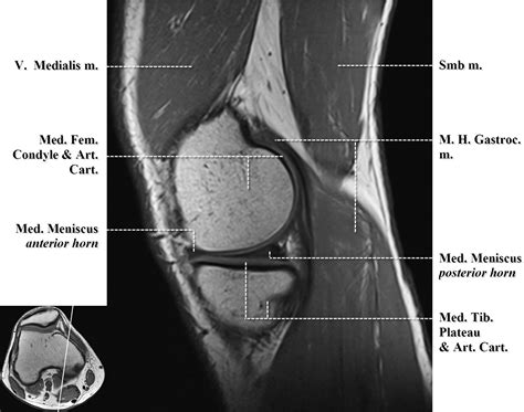 Normal MR Imaging Anatomy of the Knee - Magnetic Resonance Imaging Clinics